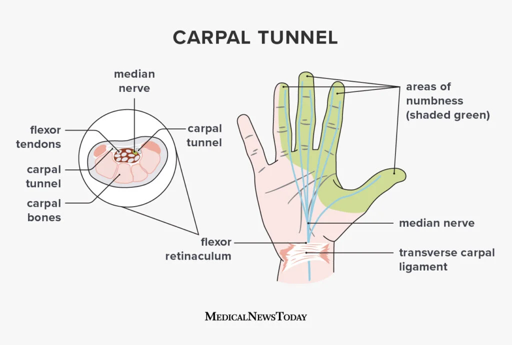 Carpel tunnel syndrome