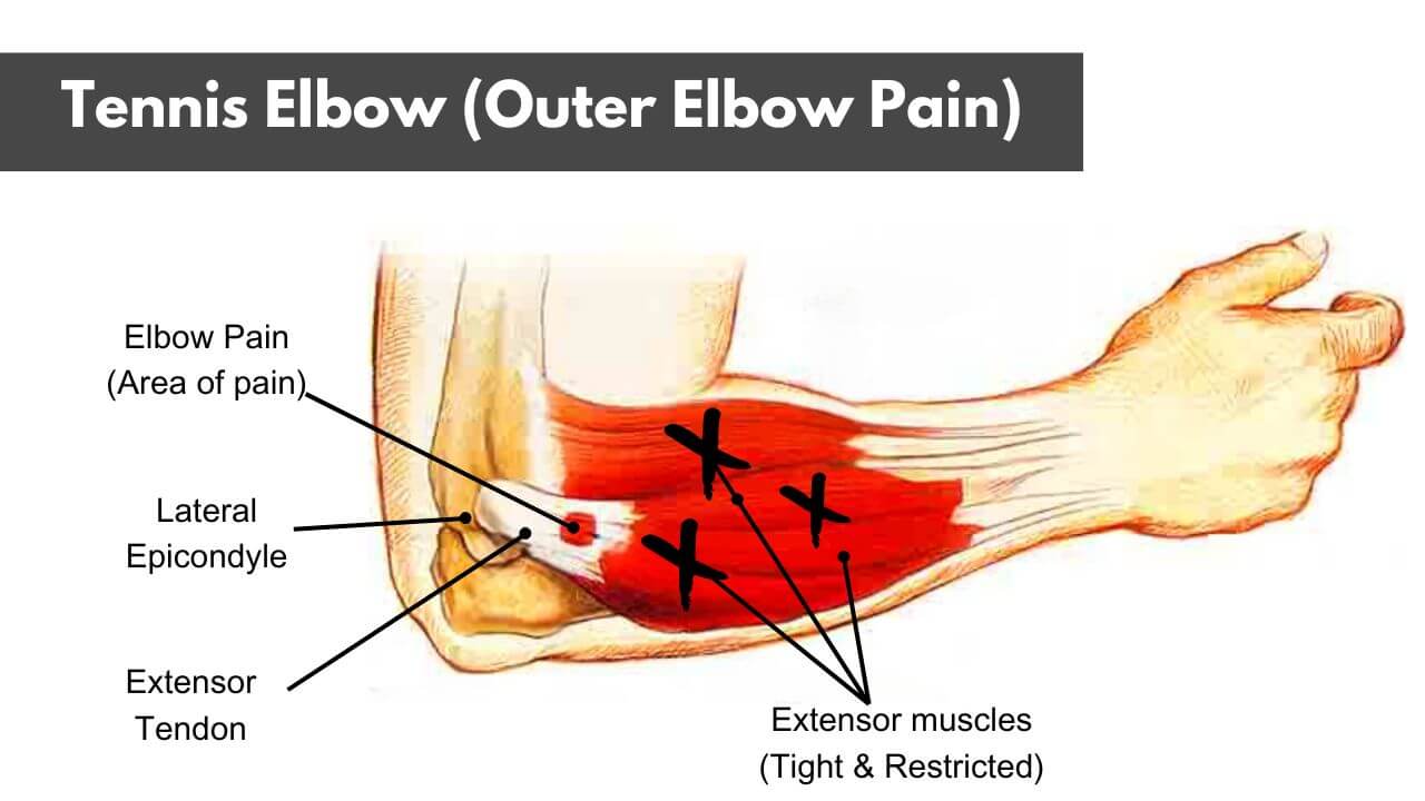 Tennis elbow